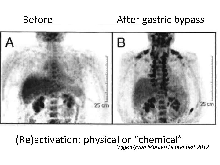 Before After gastric bypass (Re)activation: physical or “chemical” Vijgen//van Marken Lichtenbelt 2012 