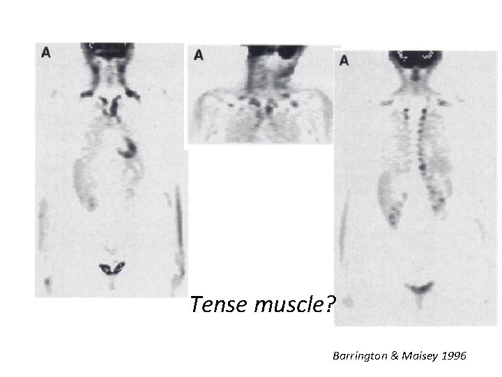Tense muscle? Barrington & Maisey 1996 