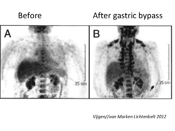 Before After gastric bypass Vijgen//van Marken Lichtenbelt 2012 