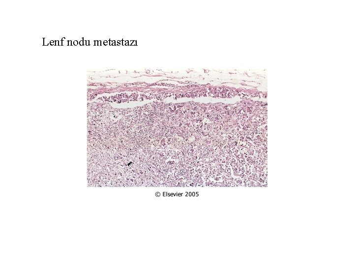 Lenf nodu metastazı 