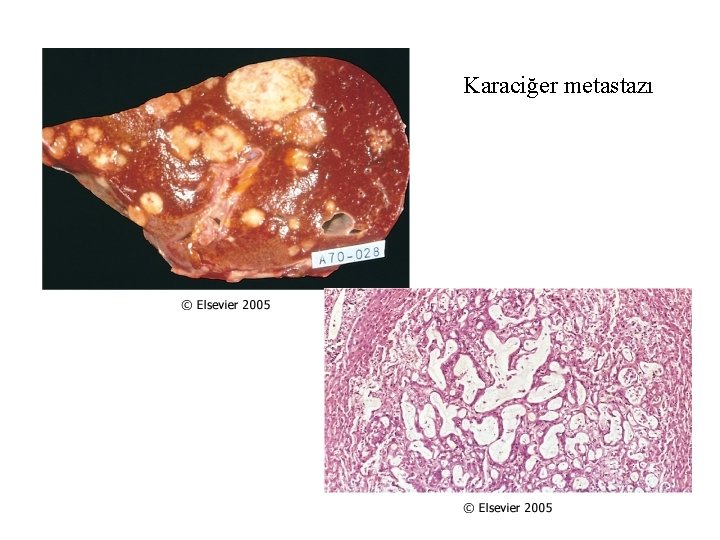 Karaciğer metastazı 