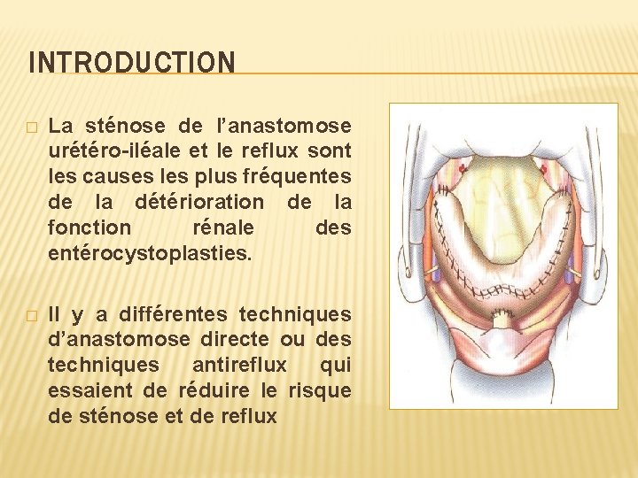 INTRODUCTION � La sténose de l’anastomose urétéro-iléale et le reflux sont les causes les