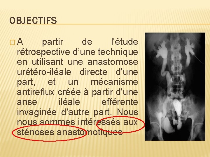 OBJECTIFS �A partir de l'étude rétrospective d’une technique en utilisant une anastomose urétéro-iléale directe