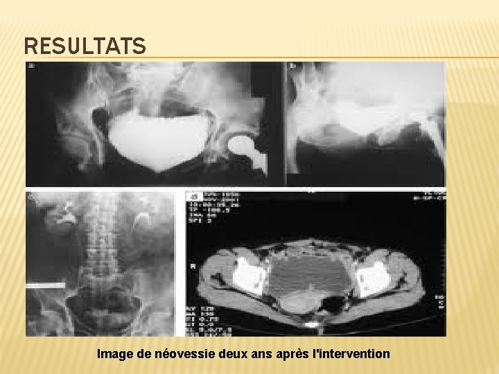 RESULTATS Image de néovessie deux ans après l'intervention 