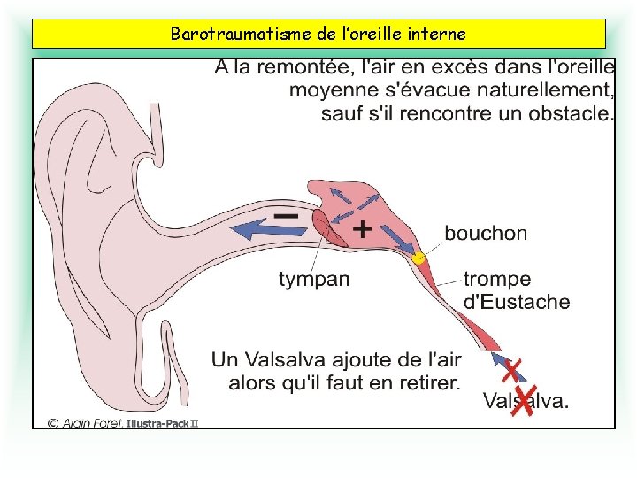 Barotraumatisme de l’oreille interne Surpression brutale de l’oreille moyenne : Oreille moyenne → système