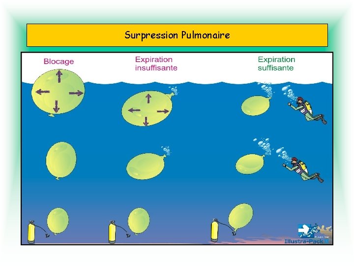 Surpression Pulmonaire Nos poumons sont constitués de petits sacs qui se remplissent et se