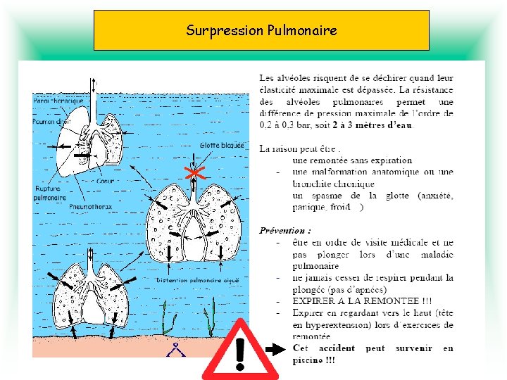 Surpression pulmonaire Pulmonaire Surpression 