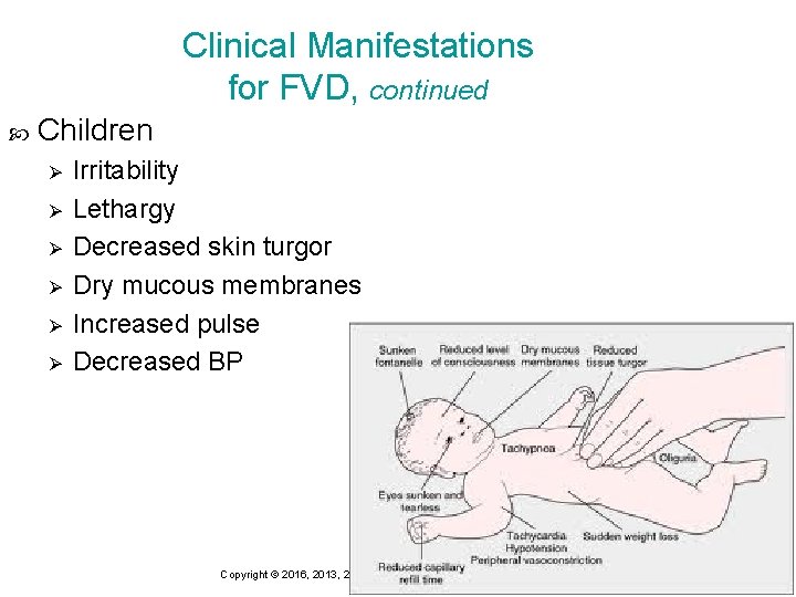 Clinical Manifestations for FVD, continued Children Ø Ø Ø Irritability Lethargy Decreased skin turgor