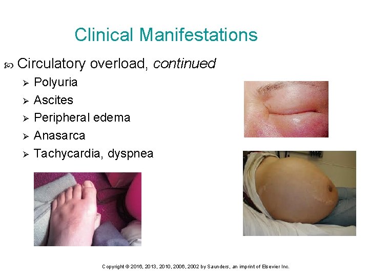 Clinical Manifestations Circulatory overload, continued Ø Ø Ø Periorbital Edema Polyuria Ascites Peripheral edema