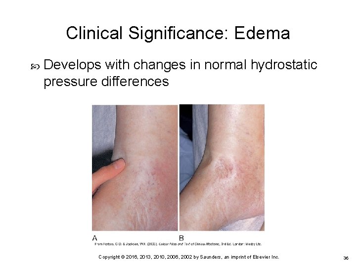 Clinical Significance: Edema Develops with changes in normal hydrostatic pressure differences 36 Copyright ©