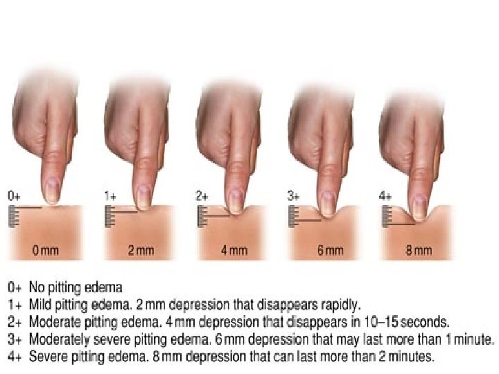 Figure 11 -22 Grading pitting edema. 37 Copyright © 2016, 2013, 2010, 2006, 2002