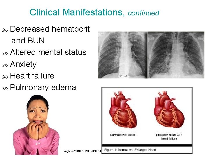 Clinical Manifestations, continued Decreased hematocrit and BUN Altered mental status Anxiety Heart failure Pulmonary