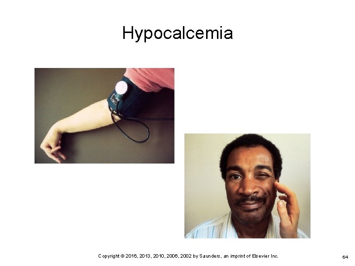 Hypocalcemia 64 Copyright © 2016, 2013, 2010, 2006, 2002 by Saunders, an imprint of
