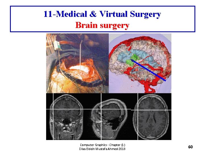 11 -Medical & Virtual Surgery Brain surgery Computer Graphics - Chapter (1) Diaa Eldein