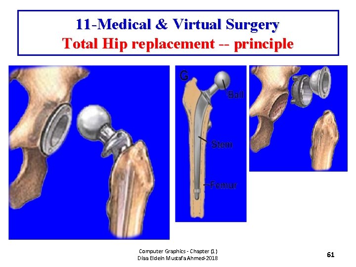 11 -Medical & Virtual Surgery Total Hip replacement -- principle Computer Graphics - Chapter