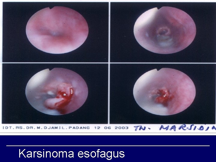 Karsinoma esofagus 