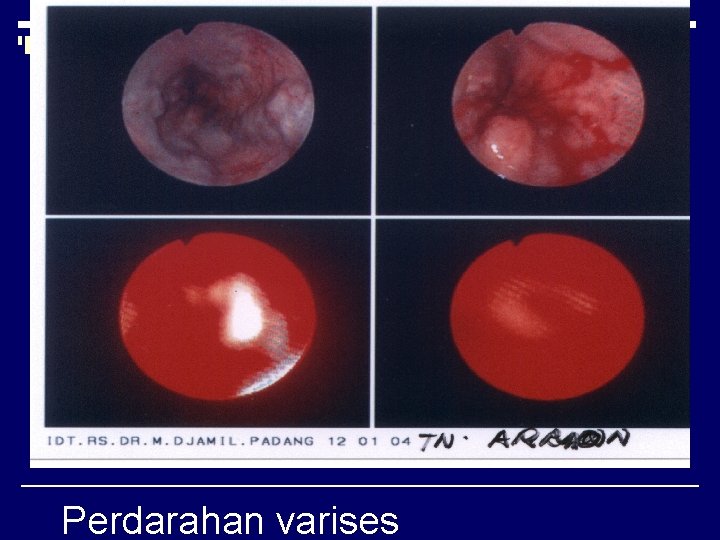 Perdarahan varises 