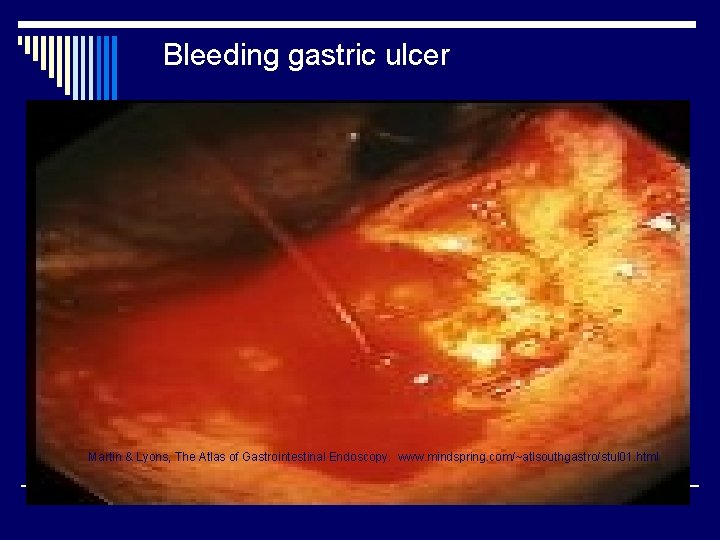 Bleeding gastric ulcer Martin & Lyons, The Atlas of Gastrointestinal Endoscopy. www. mindspring. com/~atlsouthgastro/stul