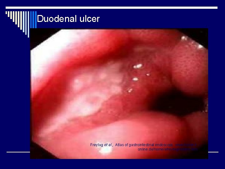 Duodenal ulcer Freytag et al. , Atlas of gastrointestinal endoscopy. www. home. tonline. de/home/afreytag/indexe.