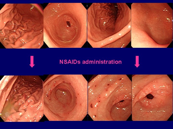 NSAIDs administration 