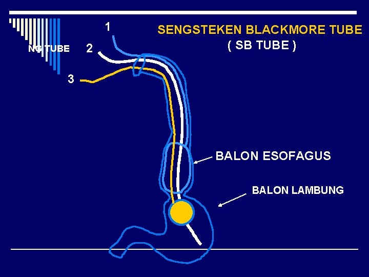 1 NG TUBE 2 SENGSTEKEN BLACKMORE TUBE ( SB TUBE ) 3 BALON ESOFAGUS