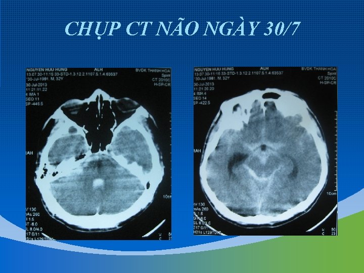 CHỤP CT NÃO NGÀY 30/7 