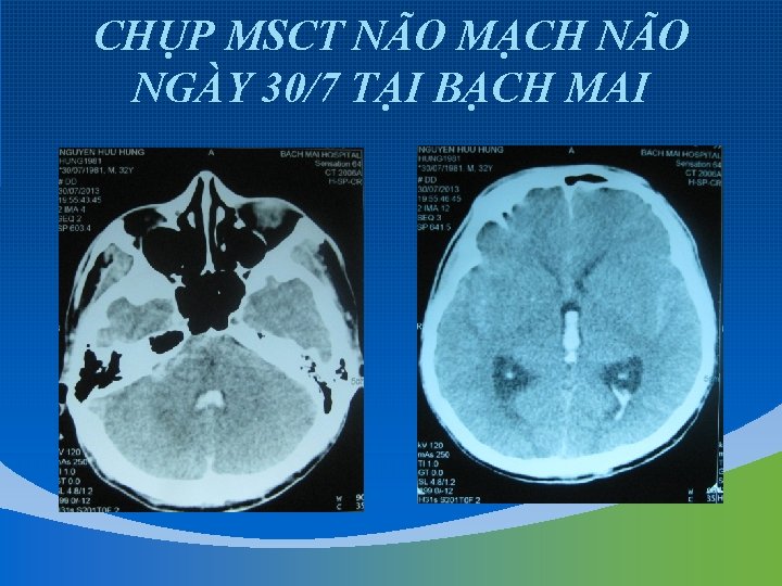 CHỤP MSCT NÃO MẠCH NÃO NGÀY 30/7 TẠI BẠCH MAI 