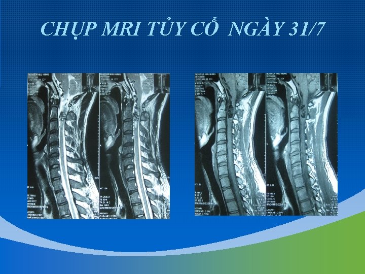 CHỤP MRI TỦY CỔ NGÀY 31/7 