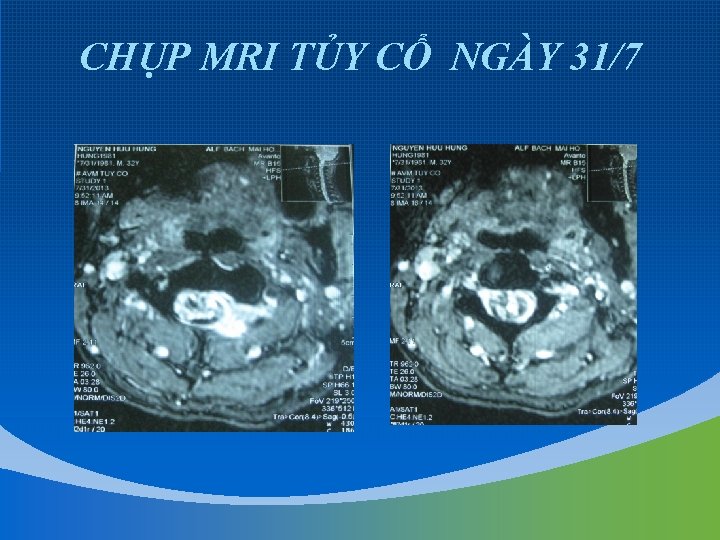 CHỤP MRI TỦY CỔ NGÀY 31/7 