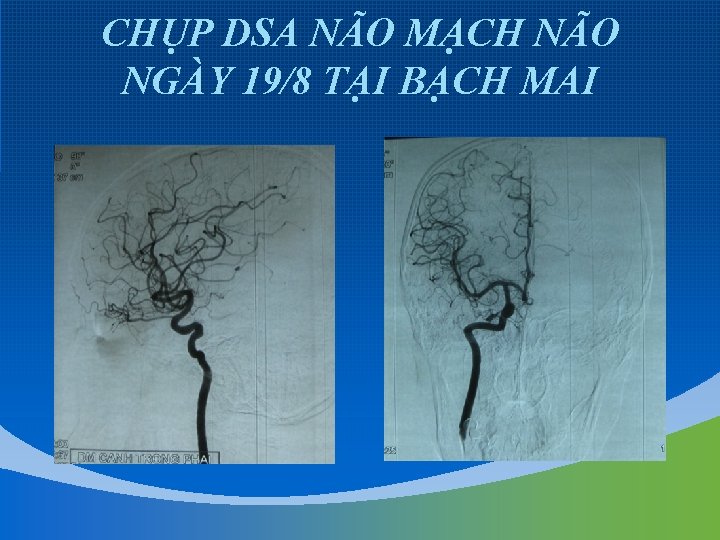 CHỤP DSA NÃO MẠCH NÃO NGÀY 19/8 TẠI BẠCH MAI 