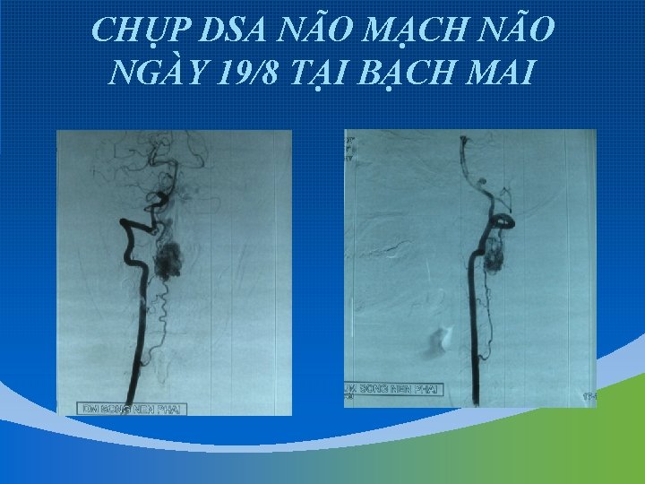 CHỤP DSA NÃO MẠCH NÃO NGÀY 19/8 TẠI BẠCH MAI 