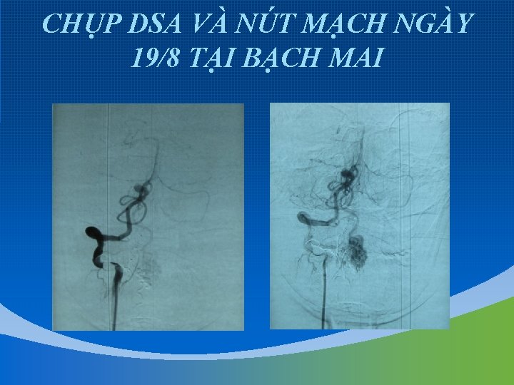 CHỤP DSA VÀ NÚT MẠCH NGÀY 19/8 TẠI BẠCH MAI 