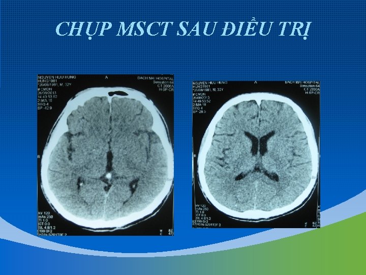 CHỤP MSCT SAU ĐIỀU TRỊ 