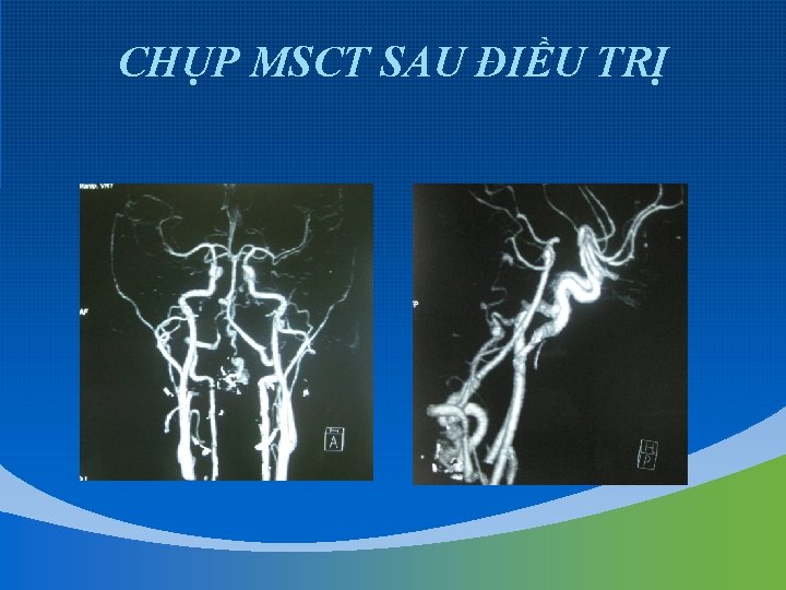 CHỤP MSCT SAU ĐIỀU TRỊ 