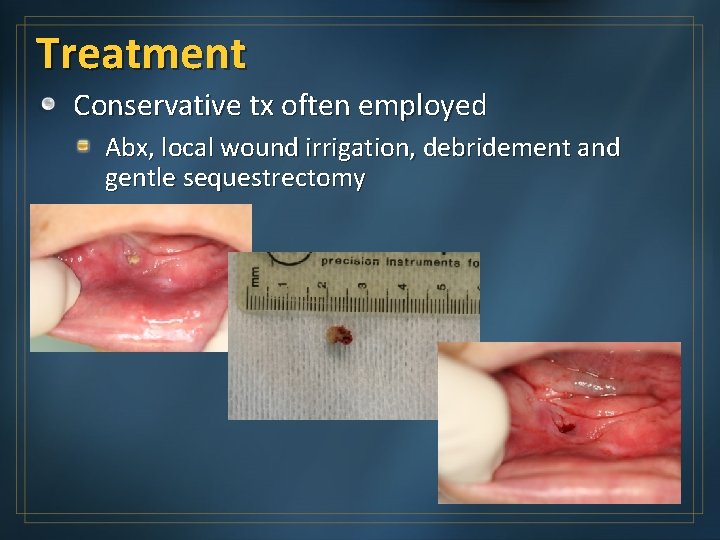 Treatment Conservative tx often employed Abx, local wound irrigation, debridement and gentle sequestrectomy 