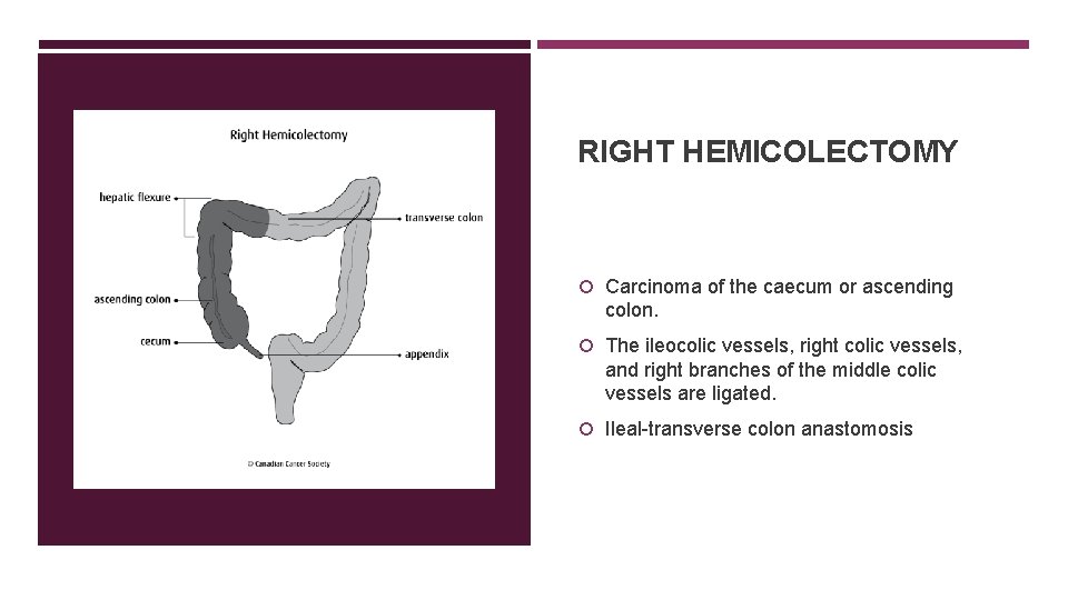 RIGHT HEMICOLECTOMY Carcinoma of the caecum or ascending colon. The ileocolic vessels, right colic