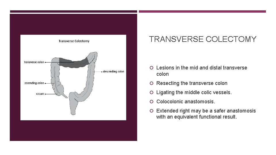 TRANSVERSE COLECTOMY Lesions in the mid and distal transverse colon Resecting the transverse colon