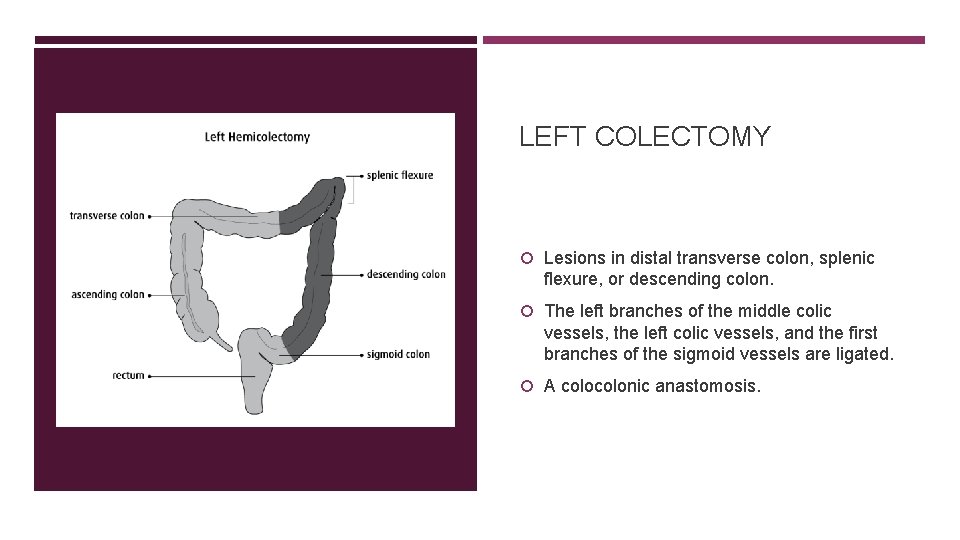 LEFT COLECTOMY Lesions in distal transverse colon, splenic flexure, or descending colon. The left