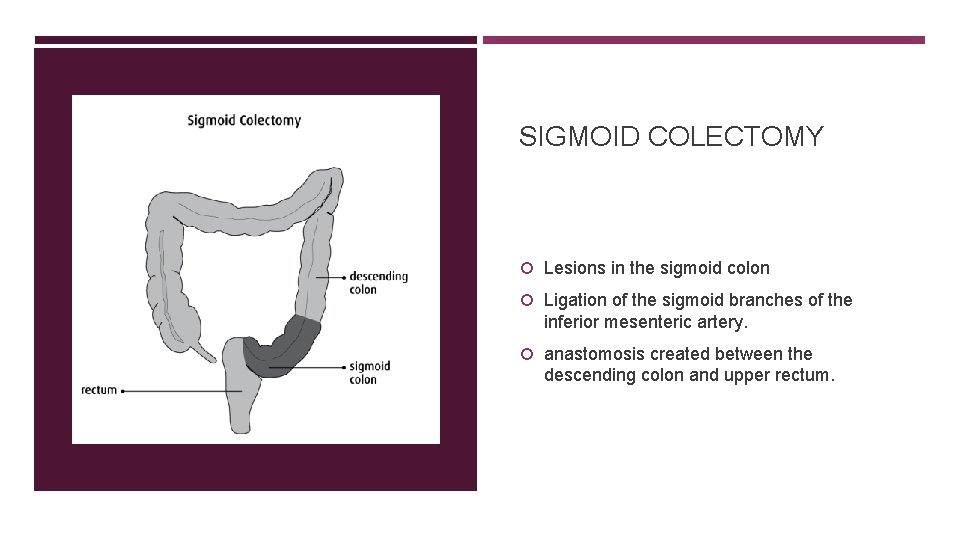 SIGMOID COLECTOMY Lesions in the sigmoid colon Ligation of the sigmoid branches of the
