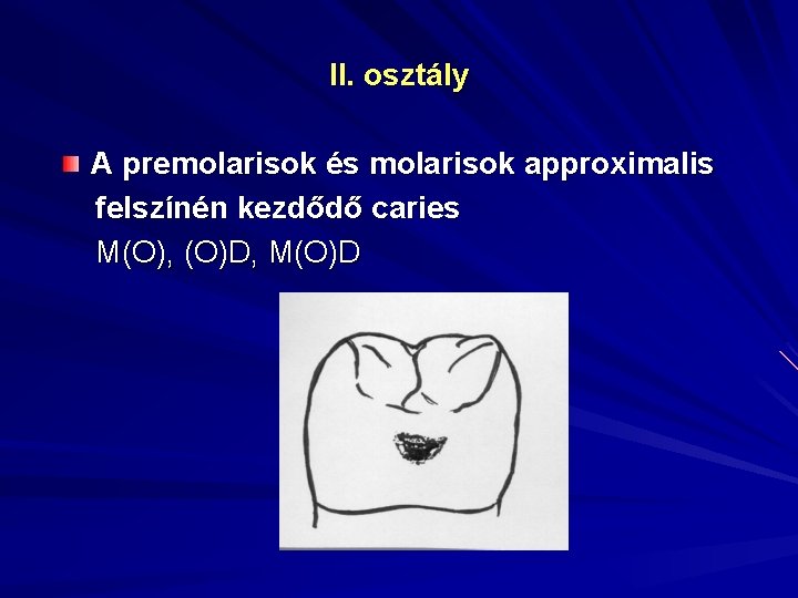 II. osztály A premolarisok és molarisok approximalis felszínén kezdődő caries M(O), (O)D, M(O)D 