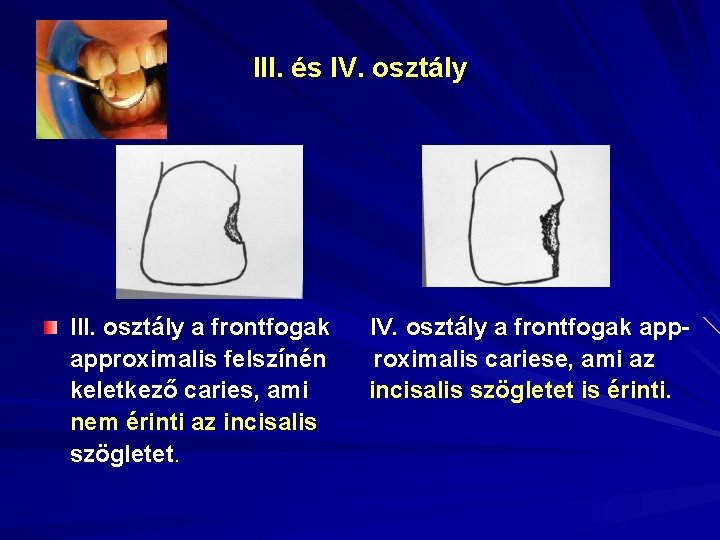 III. és IV. osztály III. osztály a frontfogak approximalis felszínén keletkező caries, ami nem