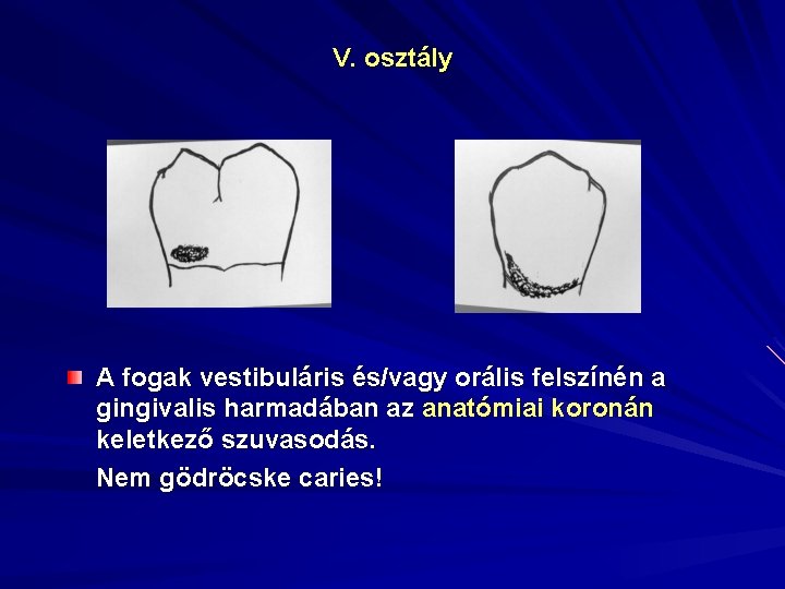 V. osztály A fogak vestibuláris és/vagy orális felszínén a gingivalis harmadában az anatómiai koronán