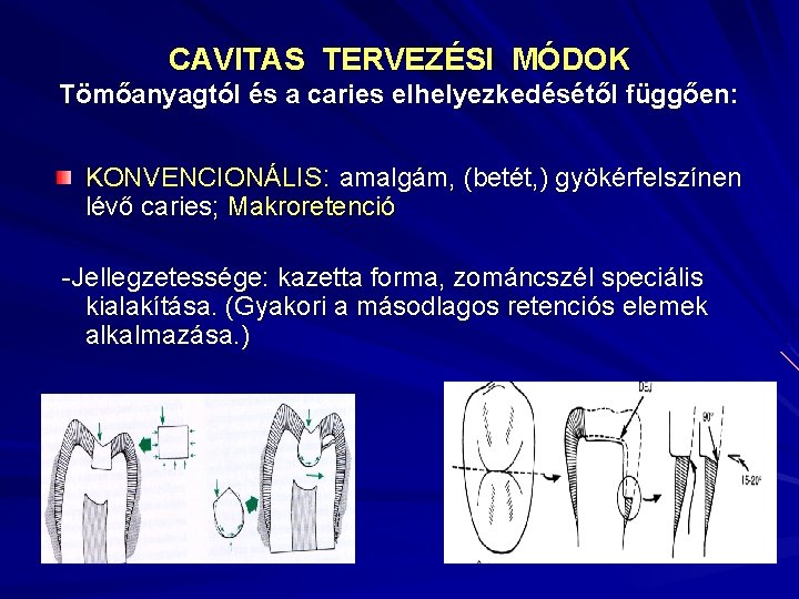 CAVITAS TERVEZÉSI MÓDOK Tömőanyagtól és a caries elhelyezkedésétől függően: KONVENCIONÁLIS: amalgám, (betét, ) gyökérfelszínen