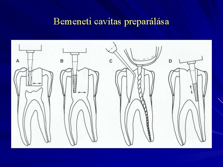 Bemeneti cavitas preparálása 