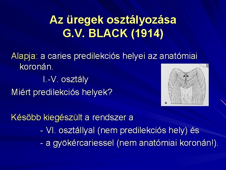 Az üregek osztályozása G. V. BLACK (1914) Alapja: a caries predilekciós helyei az anatómiai