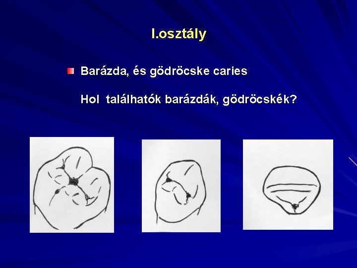 I. osztály Barázda, és gödröcske caries Hol találhatók barázdák, gödröcskék? 