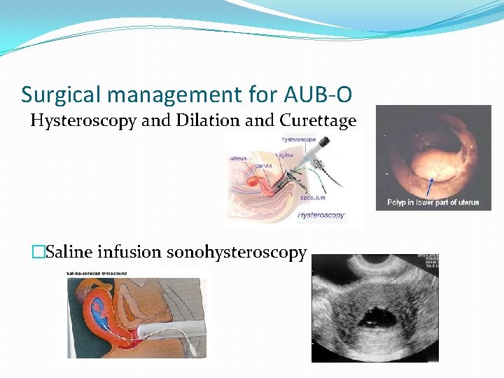 Surgical management for AUB-O Hysteroscopy and Dilation and Curettage �Saline infusion sonohysteroscopy 