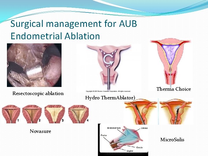 Surgical management for AUB Endometrial Ablation Resectoscopic ablation Therma Choice Hydro Therm. Ablator) Novasure