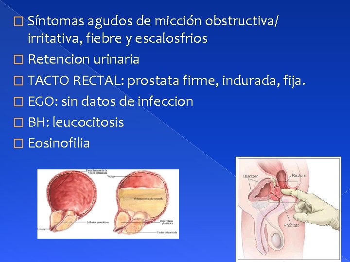 � Síntomas agudos de micción obstructiva/ irritativa, fiebre y escalosfrios � Retencion urinaria �