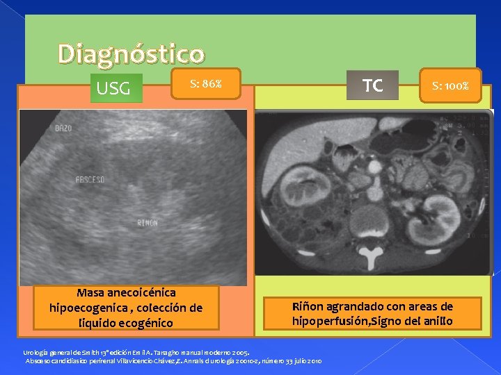 Diagnóstico USG TC S: 86% Masa anecoicénica hipoecogenica , colección de liquido ecogénico S: